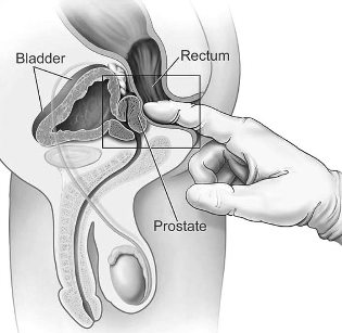 masajul prostatei